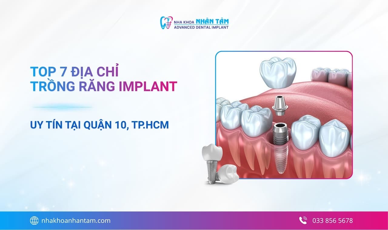 Top 10+ địa chỉ trồng răng Implant uy tín tại Quận 10, TP.HCM năm 2026
